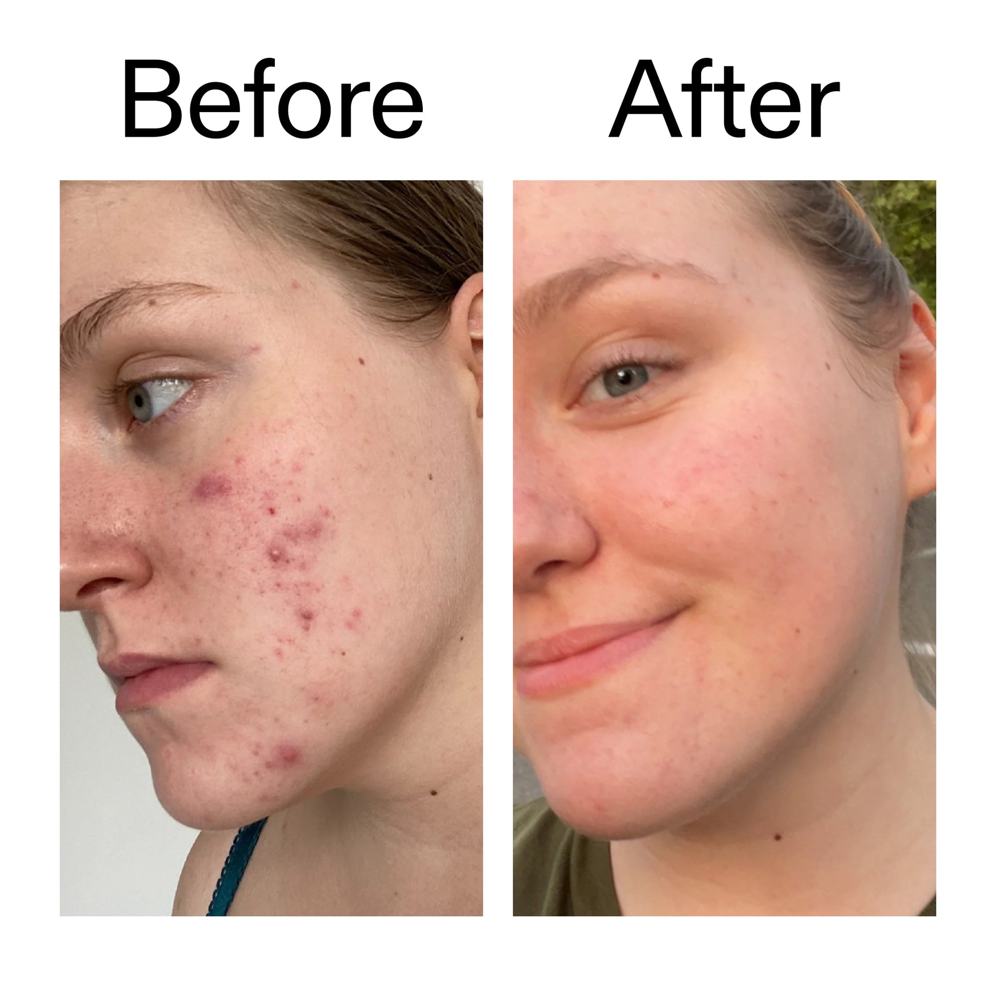 15-vitamin-c-egf-serum-p9 15_Vitamin_C_EGF_Serum_Before_After_2000x2000_fb9f598a-3386-40c8-8143-36f9d7a17ec8.jpg