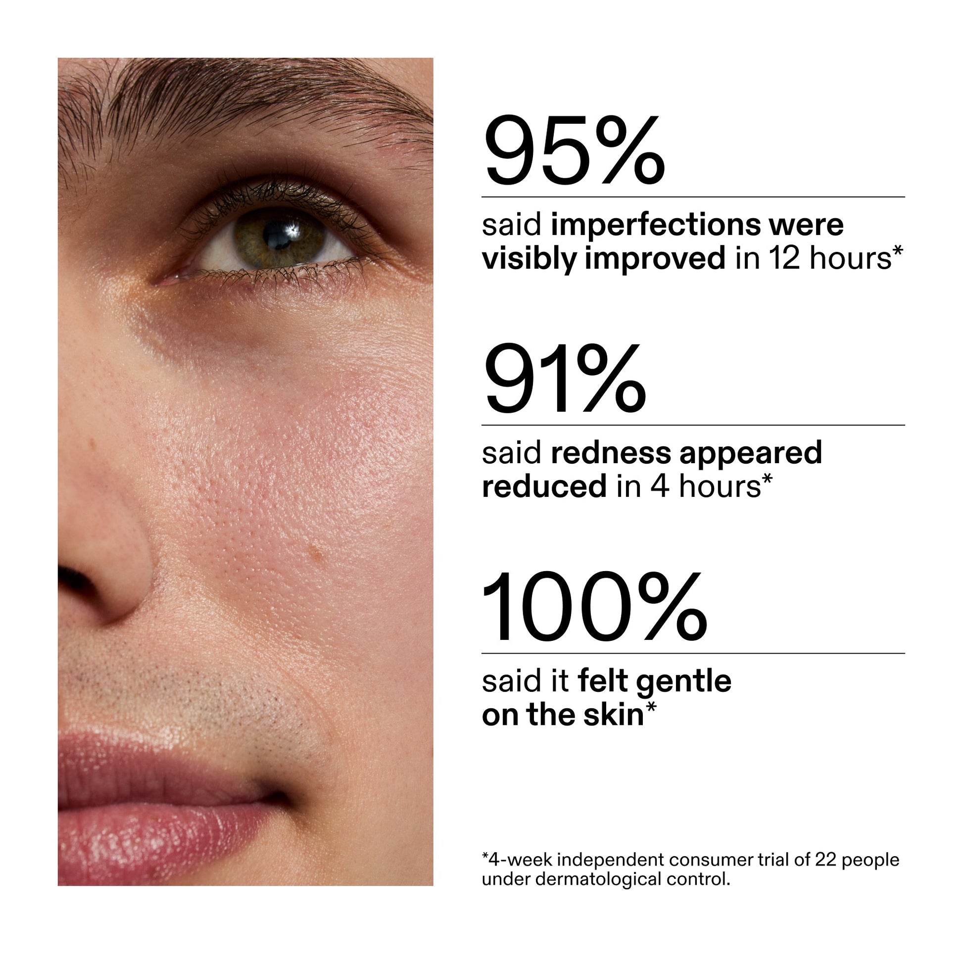 succinic-acid-acne-treatment-n6 CA_Succinic_Acid_Treatment_key_Claims_2000x2000_db91b0f1-7f29-4bfe-bb16-63a47f500960.jpg