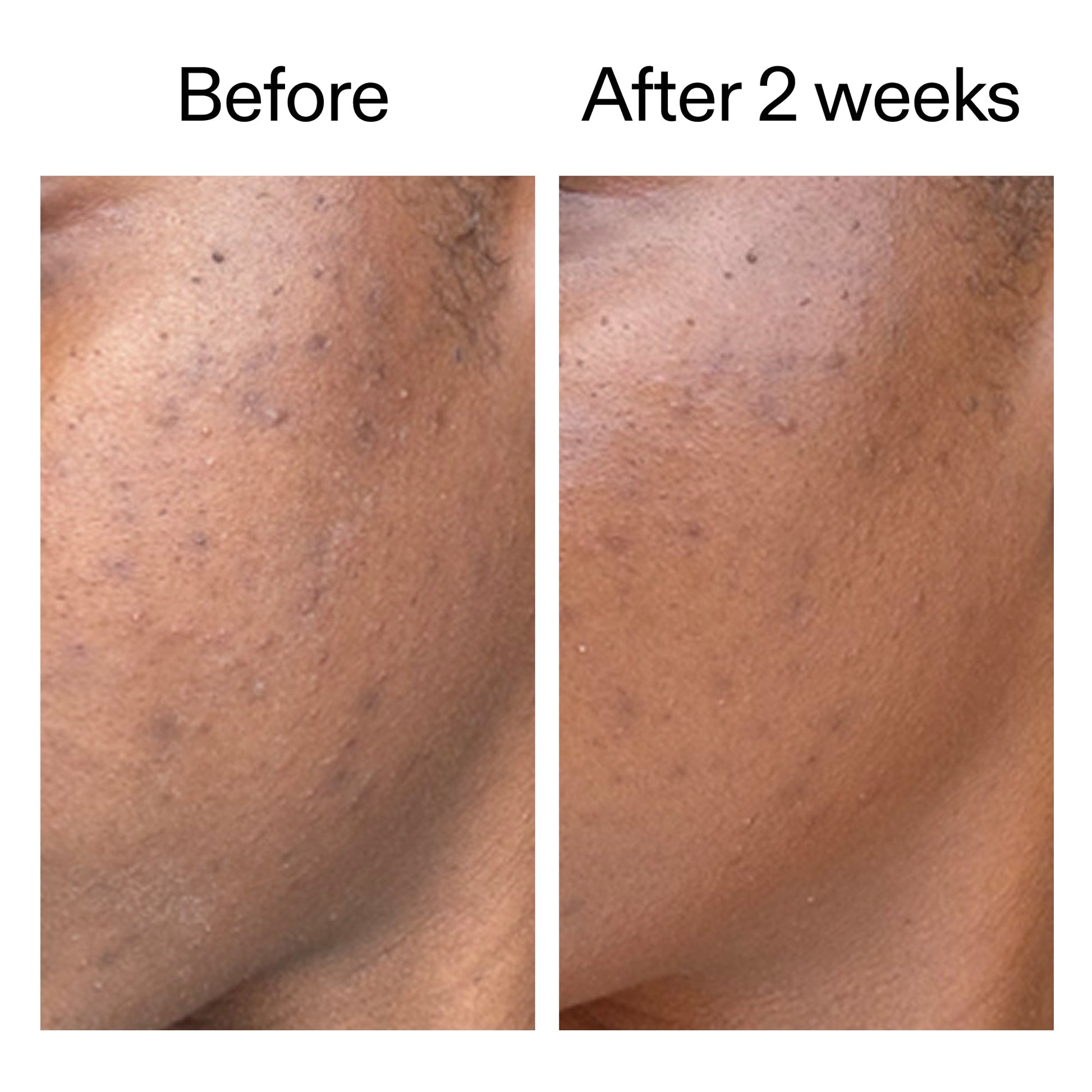 360-acne-clearing-serum-k3 DIOICB_A2000x2000.jpg
