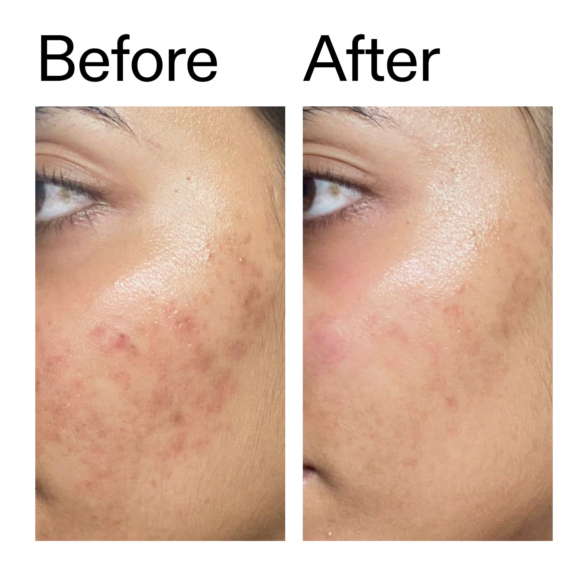 ectoin-hydro-barrier-serum-m5 Ectoin_Hydro-barrier_Serum__Before_After_2000x2000_34261920-d004-48d0-9c7b-8e1c15971bfd.jpg