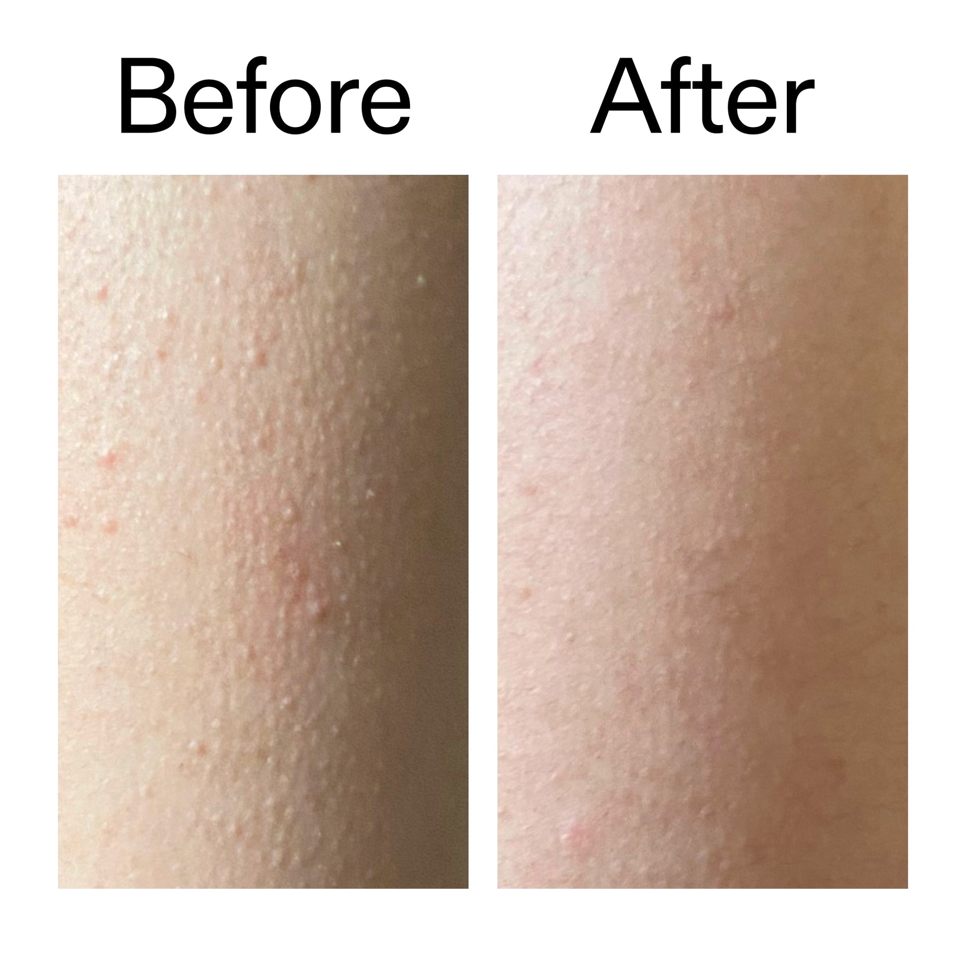 glycolic-acid-exfoliating-body-stick-duo-c5 Glycolic_Acid_Exfoliating_Body_Stick_Before_After_V2_2000x2000_2e4ba052-94f6-4d56-82df-7bdb5b2df7ae.jpg
