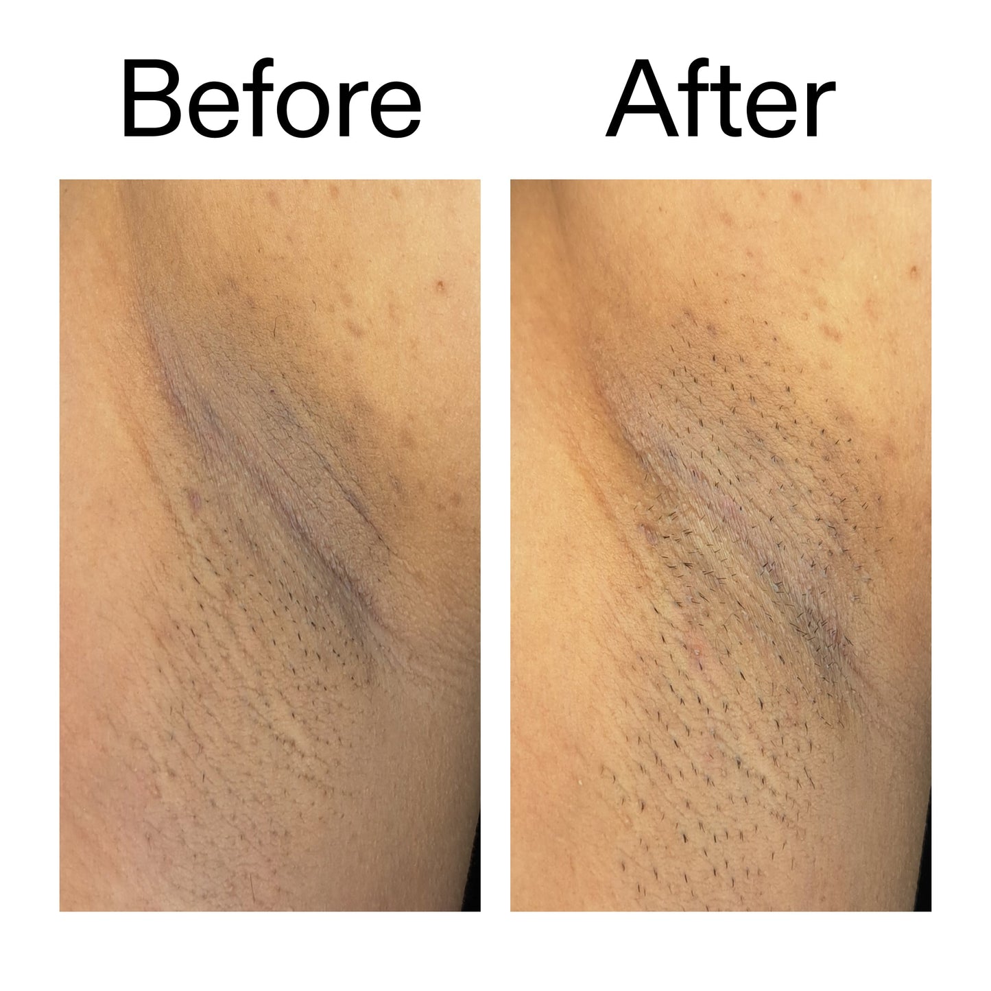 glycolic-acid-exfoliating-body-stick-duo-c5 Glycolic_Acid_Exfoliating_Body_Stick_Before_After_V3_2000x2000_ea919cd9-1439-4a46-82a0-76200eb5bb42.jpg