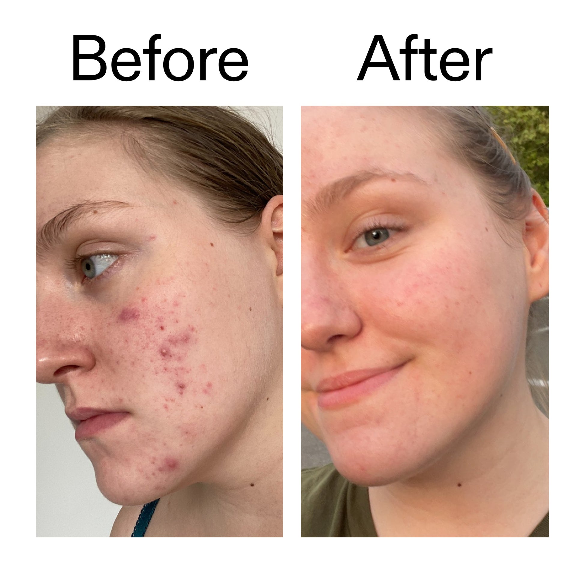 glycolic-acid-toner-x9 Glycolic_Acid_Toner_Before_After_2000x2000_49f0b9f7-e71b-4b2e-a8f8-2ea4b73247bb.jpg