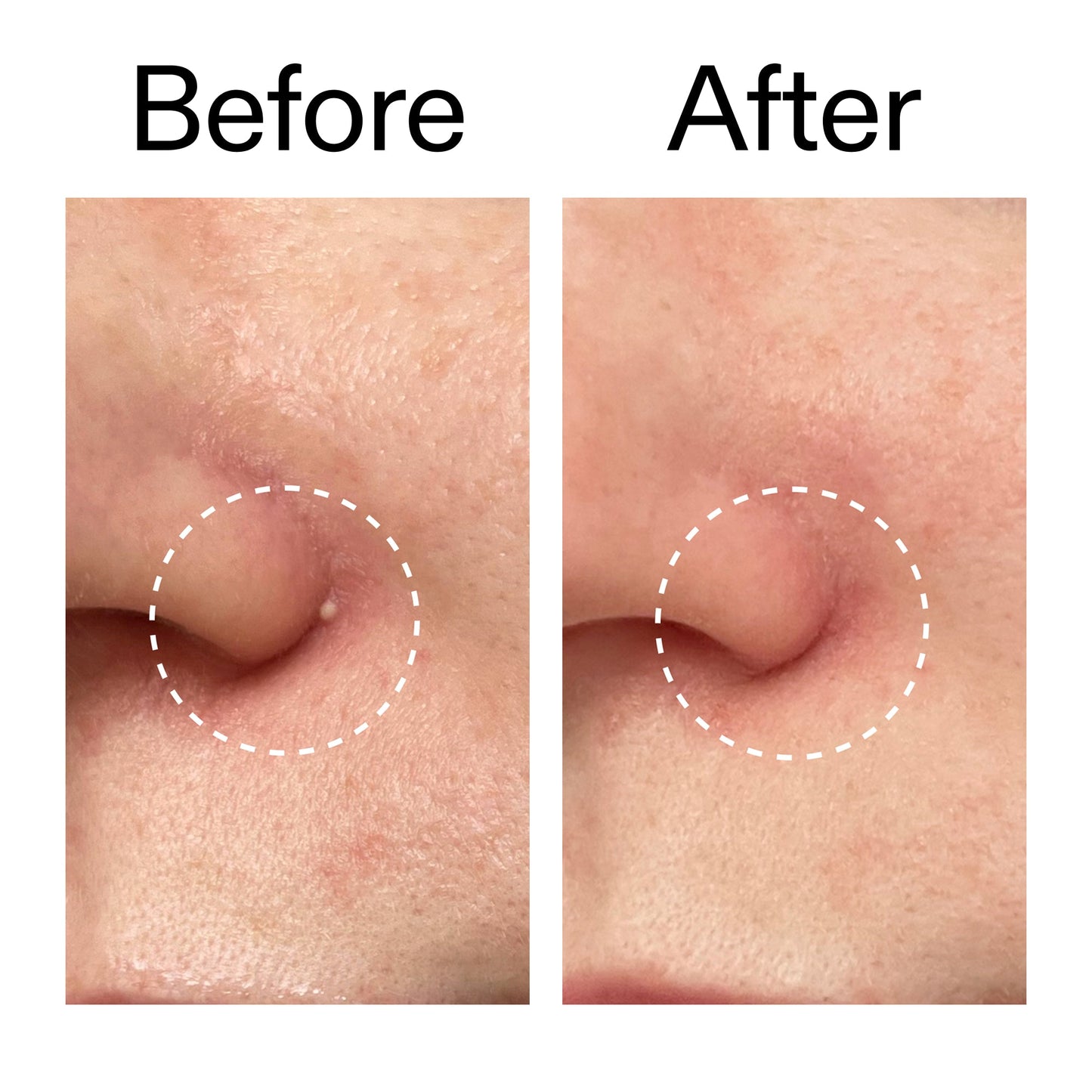hydrocolloid-invisible-pimple-patches-pack-of-44-v3 Hydrocolloid_Invisible_Pimple_Patches_Before_After_2000x2000_b02aa37b-c78a-4682-91de-9135af5bb7df.jpg