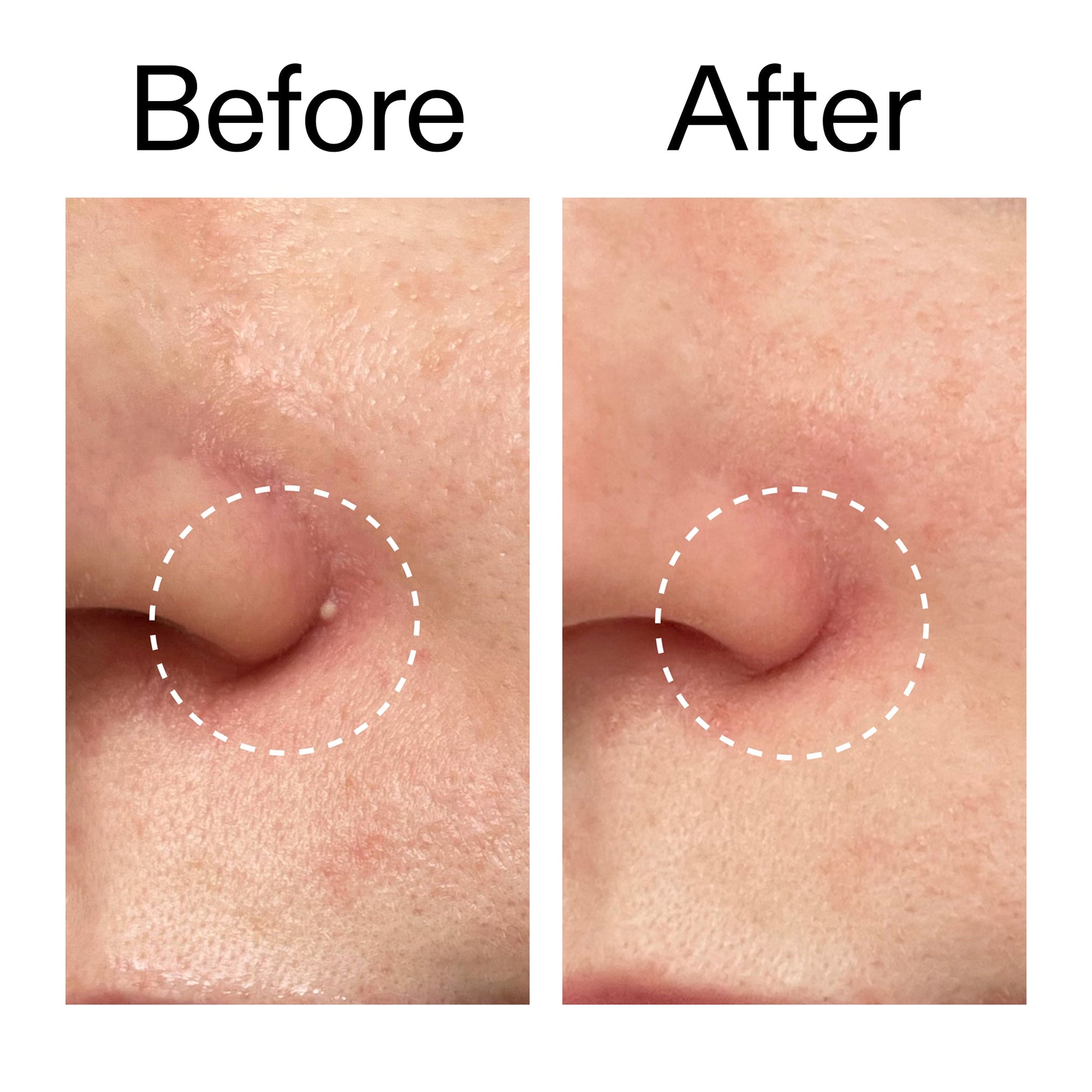 hydrocolloid-invisible-pimple-patches-pack-of-44-v3 Hydrocolloid_Invisible_Pimple_Patches_Before_After_2000x2000_b02aa37b-c78a-4682-91de-9135af5bb7df.jpg