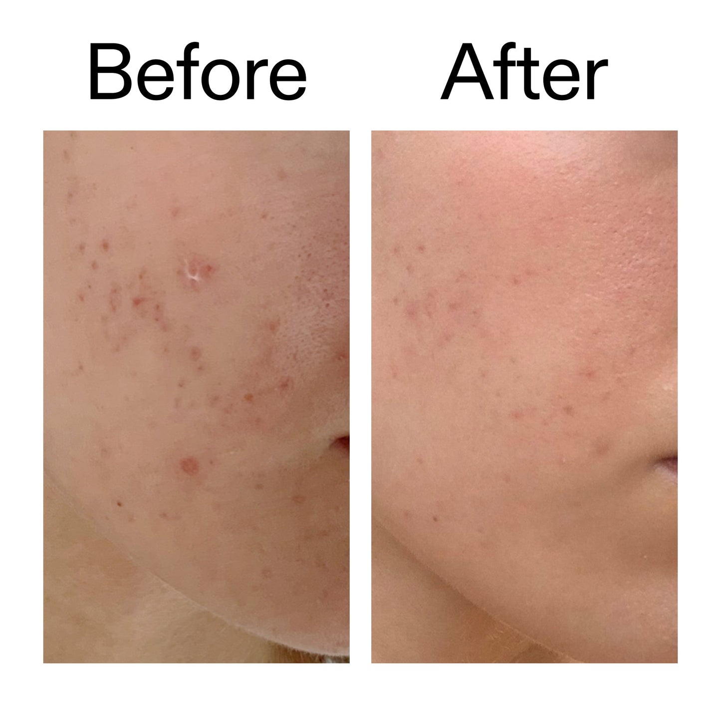 mandelic-acid-treatment-y8 Mandelic_Acid_Treatment_Before_After_2000x2000_4885ac6e-c5d7-4279-a72a-1417af7dce35.jpg