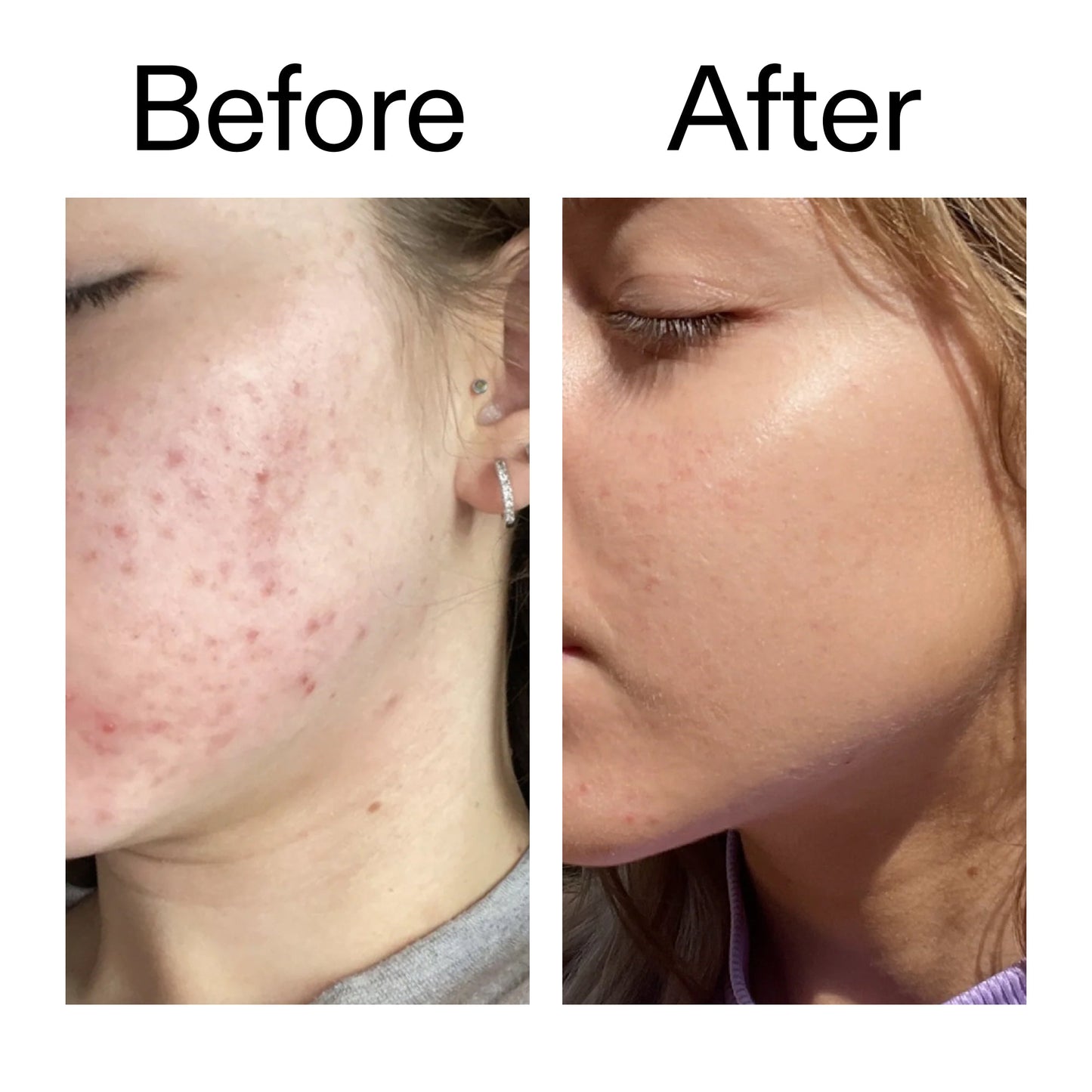 10-niacinamide-serum-duo-c1 Niacinamide_Serum_Before_After_2000x2000_bde32455-9e7d-448e-b053-bef41504f0a9.jpg