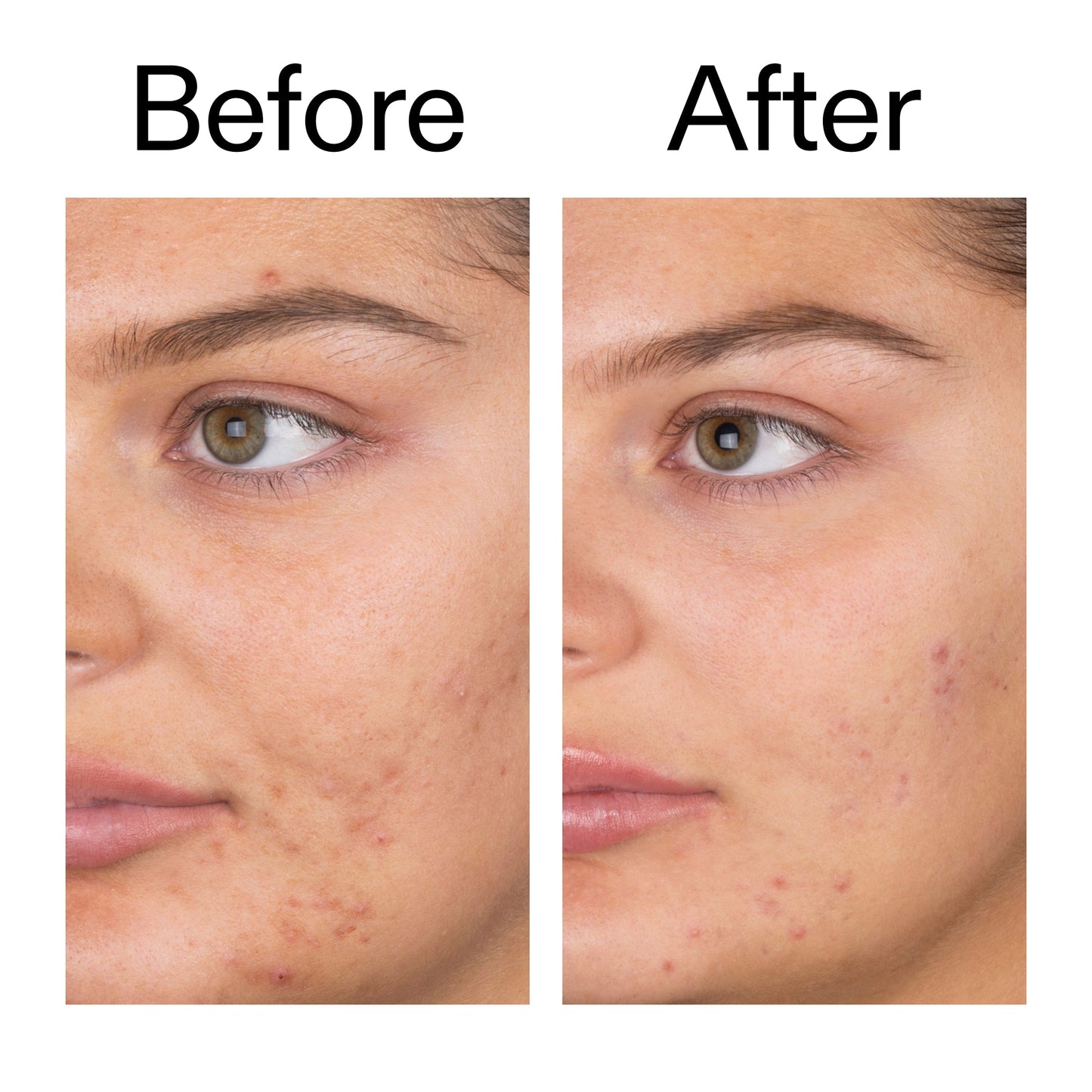 salicylic-acid-cleanser-150ml-y4 Salicylic_Acid_Cleanser_-_150ml_Before_After_2000x2000_e7230494-853f-4b07-82b1-27669104c995.jpg