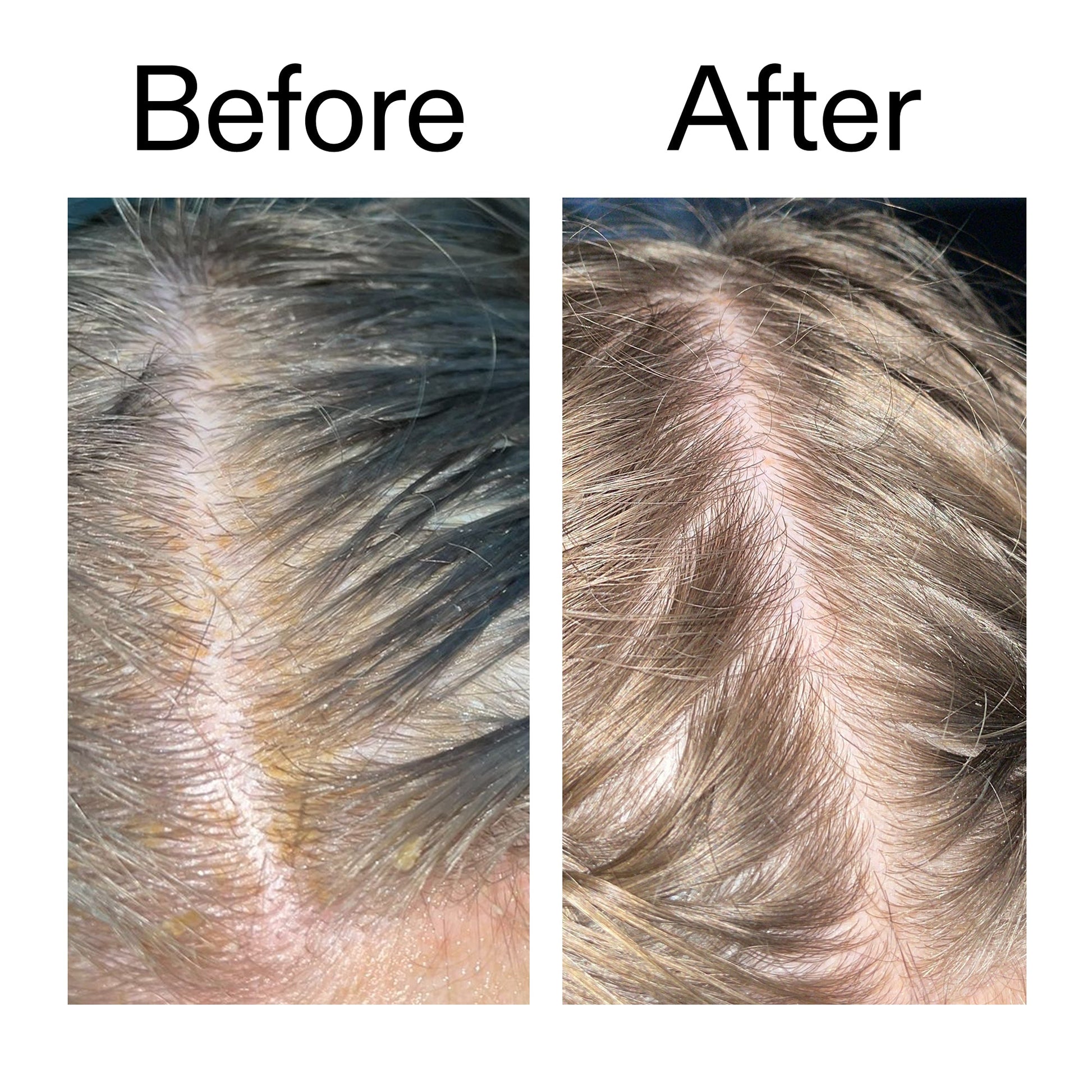 salicylic-acid-exfoliating-scalp-treatment-b8 Salicylic_Acid_Exfoliating_Scalp_Treatment_Before_After_2000x2000_e572a30f-057c-4a48-823b-1c09dc97f8d0.jpg