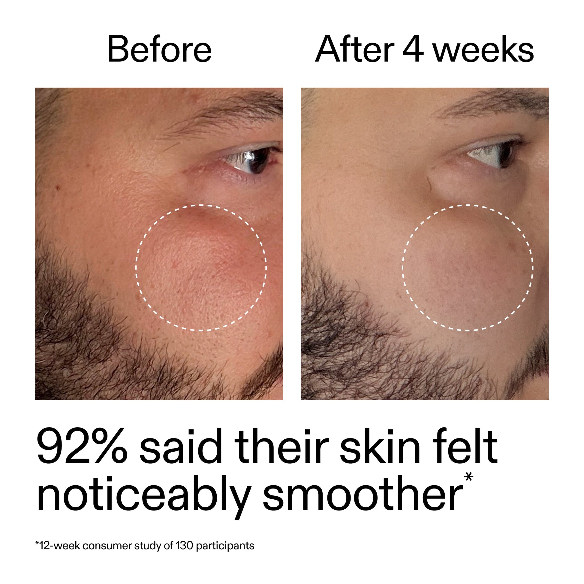 starter-retinol-serum-duo-m2 StarterRetinol_BeforeAfter_Claim3_2000x2000_458243a8-bbb0-4e5d-a274-29c7766d339b.jpg