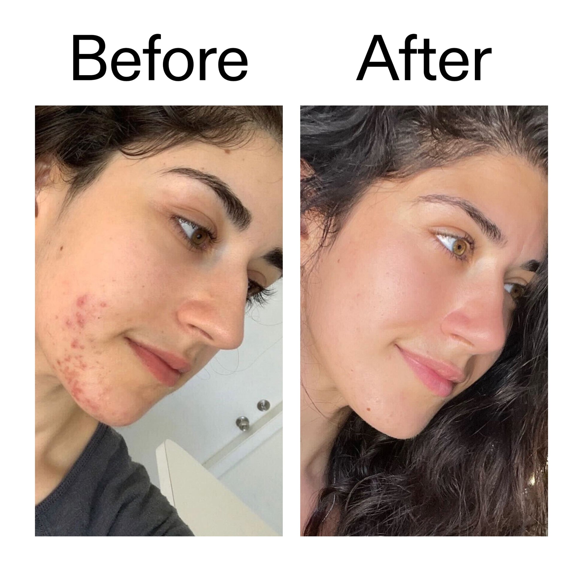 succinic-acid-acne-treatment-n6 Succinic_Acid_Treatment_Before_After_2000x2000_6a5f0054-2f58-4433-9314-0dc72c9bdd3b.jpg