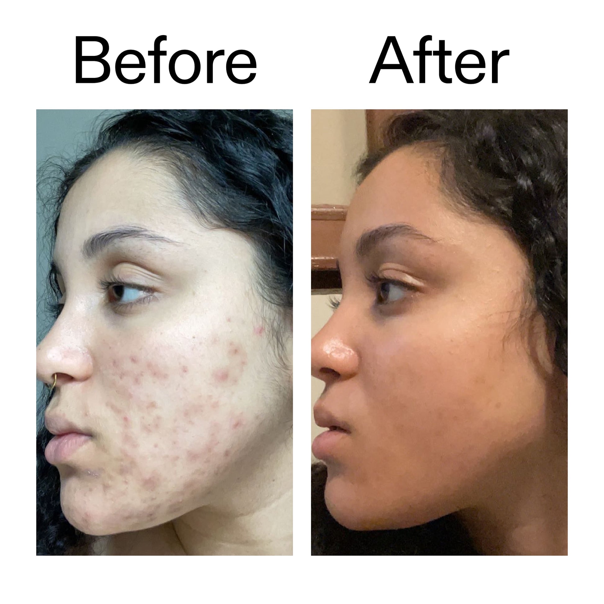 tranexamic-acid-serum-k4 Tranexamic_Acid_Serum_Before_After_2000x2000_98ebc8be-77b0-4843-8a22-90790ebe918b.jpg